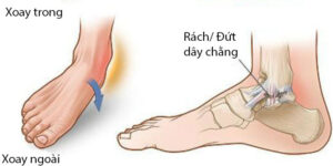 Viêm khớp cổ chân nguyên nhân và cách điều trị